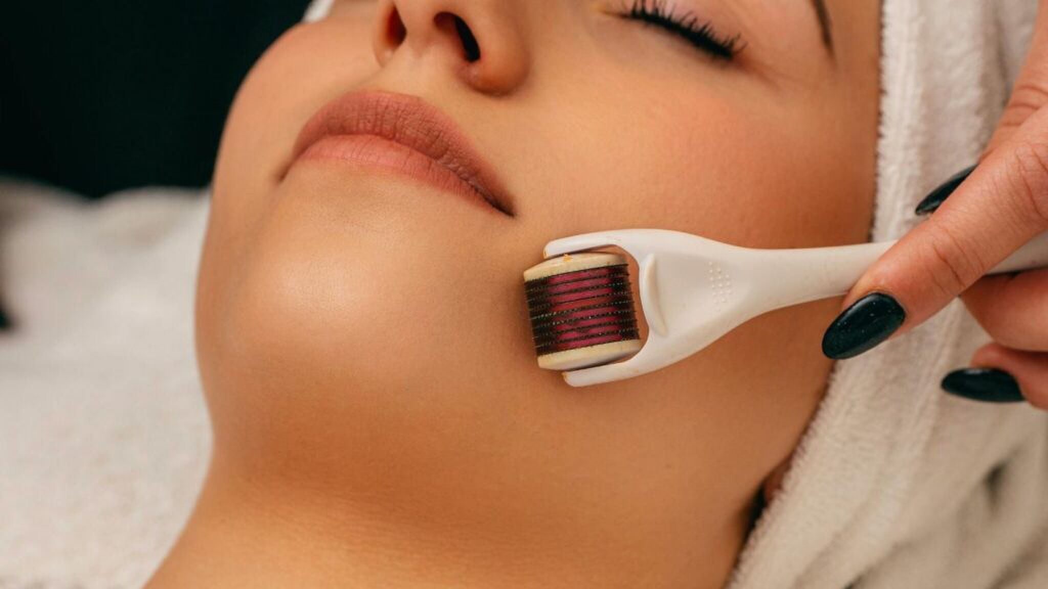 Microneedling.