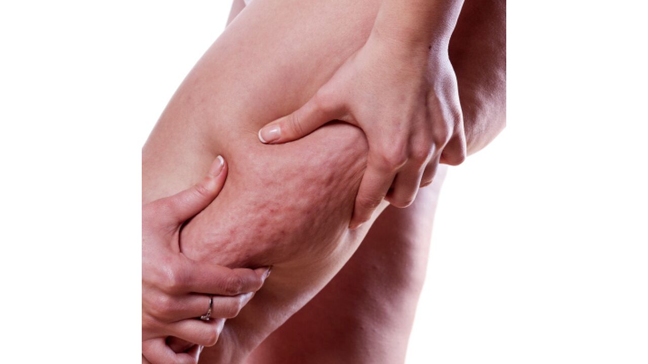 Illustratie voor: 6 dingen die je moet weten over cellulite