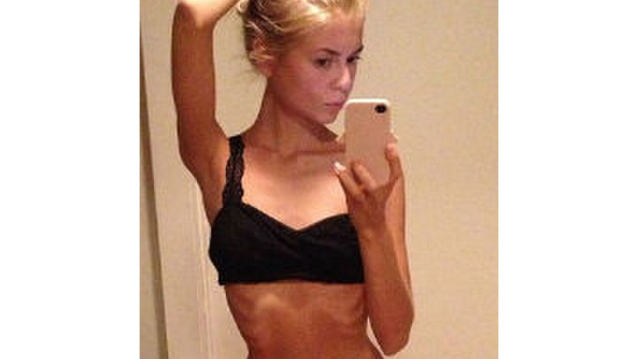 Illustratie voor: Meisje met anorexia werd beter door Instagram