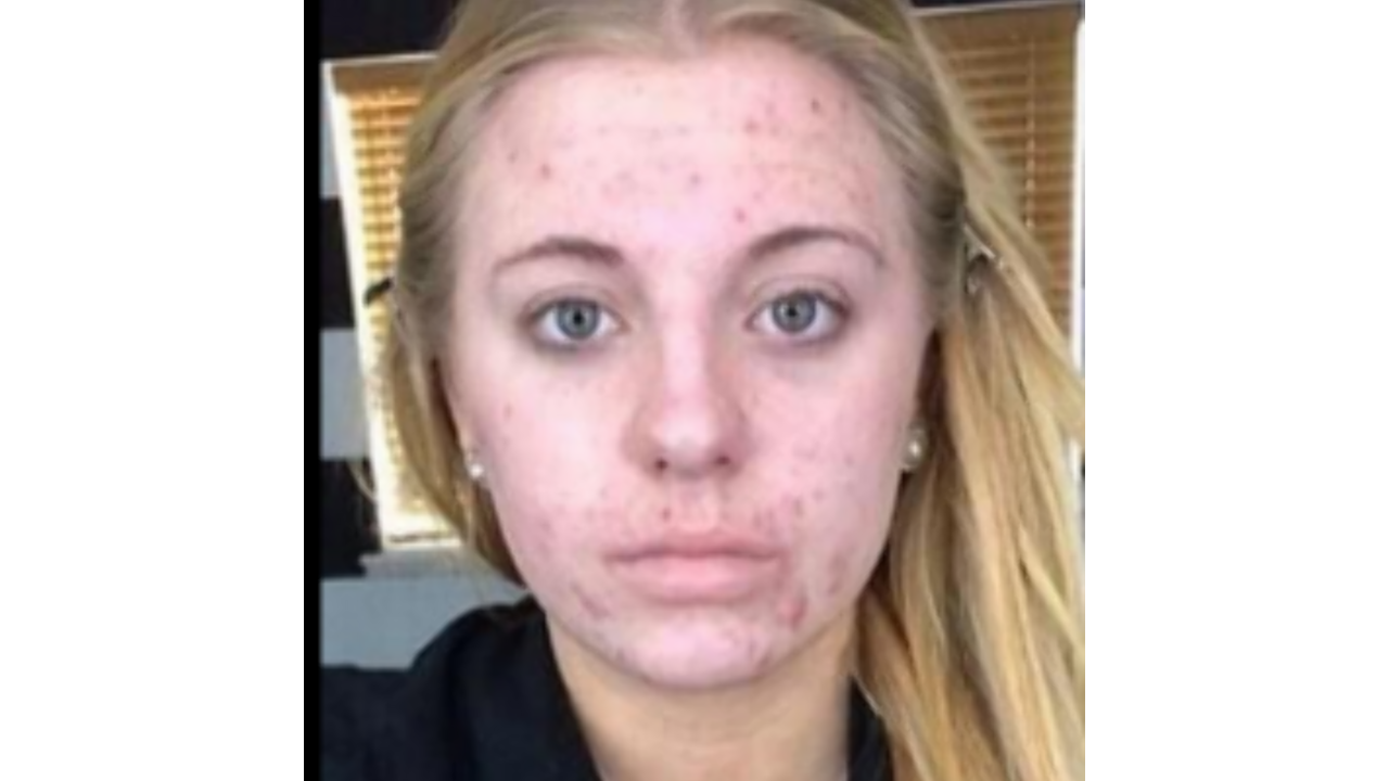 Illustratie voor: Meisje met acne reageert op haters na gemene meme