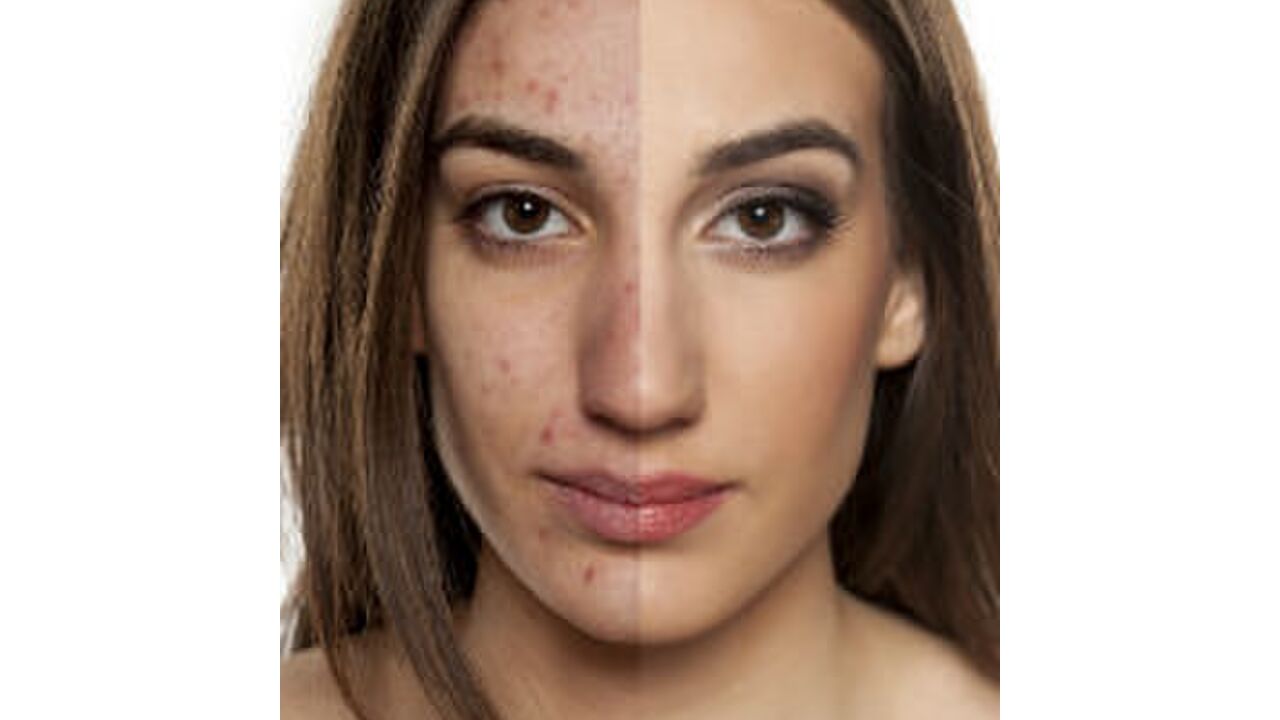 Illustratie voor: Meisje onthult geheim van acne-transformatie in slechts 3 maanden tijd