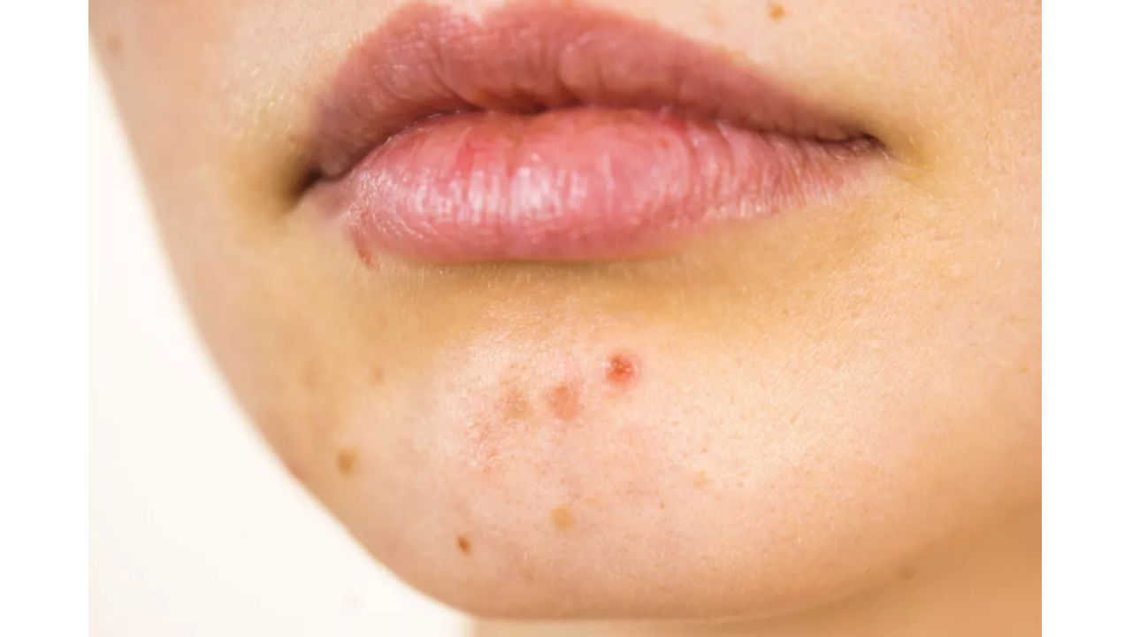 Illustratie voor: Dit is hoe je littekens van acne kunt laten verwijderen