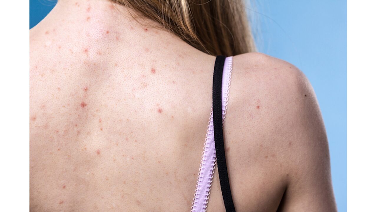 Illustratie voor: Met deze tips ga je acne op je rug tegen