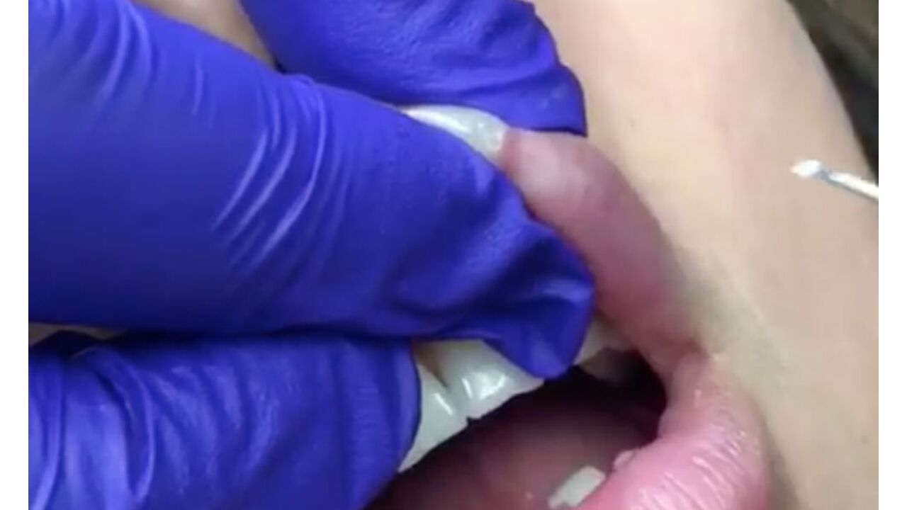 Illustratie voor: Gek op puistenvideo’s? Zie dan hier hoe een lipfiller puist uitgeknepen wordt