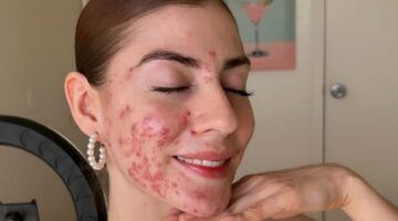 meisje met acne