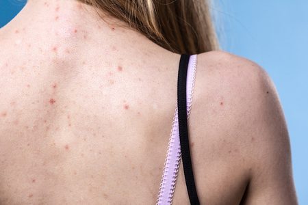 Illustratie voor: Met deze tips ga je acne op je rug tegen