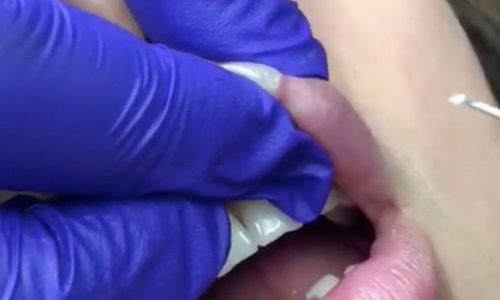 Illustratie voor: Gek op puistenvideo’s? Zie dan hier hoe een lipfiller puist uitgeknepen wordt
