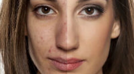 Illustratie voor: Meisje onthult geheim van acne-transformatie in slechts 3 maanden tijd