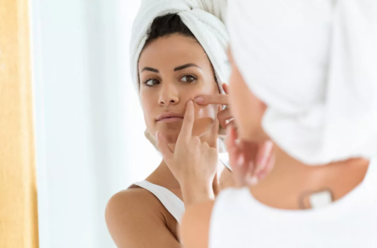 Dit is hormonale acne en dit is de oplossing ervoor
