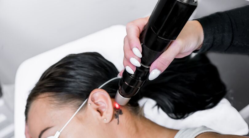 Een tattoo weglaseren? Dit is wat je kunt verwachten