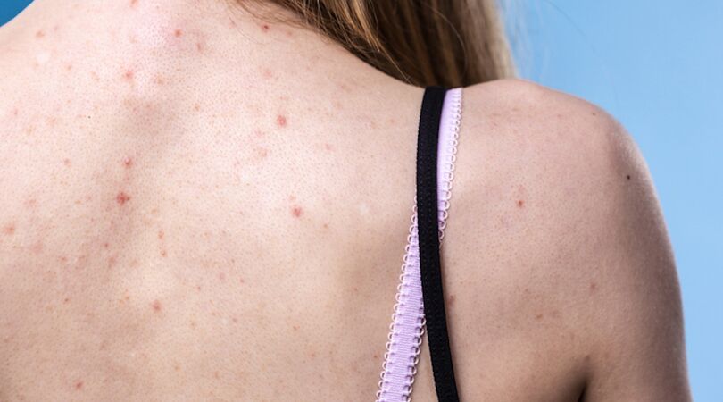 Met deze tips ga je acne op je rug tegen