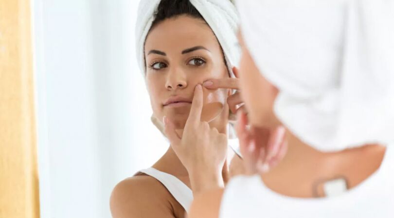 Dit is hormonale acne en dit is de oplossing ervoor