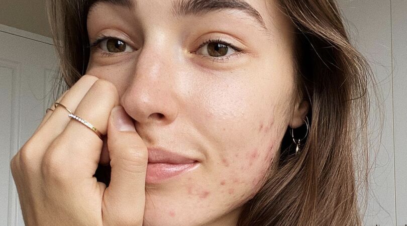 huid-reinigen-hannah